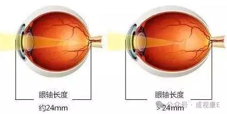 】高度近视人群这几条内容务必知道！尊龙凯时人生就是搏平台【爱眼小课堂(图3)